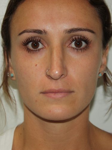 Rhinoplasty Patient 35 - Before - 3