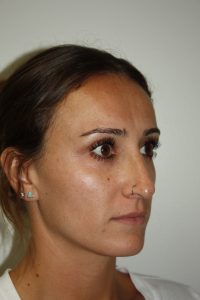 Rhinoplasty Patient 35 - Before - 1 Thumbnail