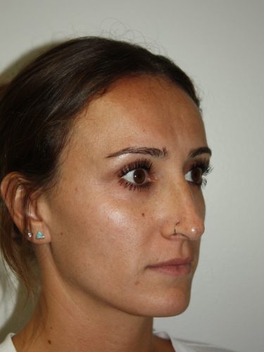 Rhinoplasty Patient 35 - Before - 1