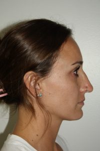 Rhinoplasty Patient 35 - Before - 2 Thumbnail