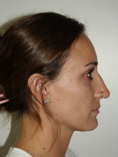 Rhinoplasty Patient 35 - Before - 2