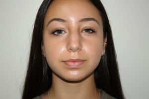 Rhinoplasty Patient 34 - Before - 3 Thumbnail