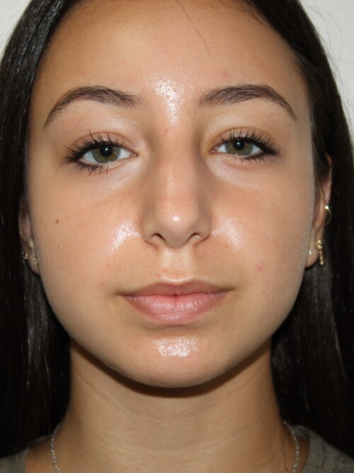 Rhinoplasty Patient 34 - Before - 3