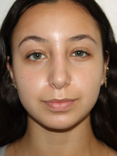 Rhinoplasty Patient 34 - After - 3