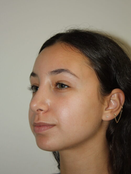 Rhinoplasty Patient 34 - After - 2