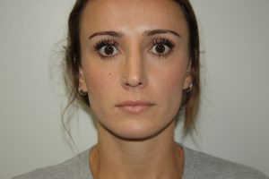 Rhinoplasty Patient 35 - After - 3 Thumbnail