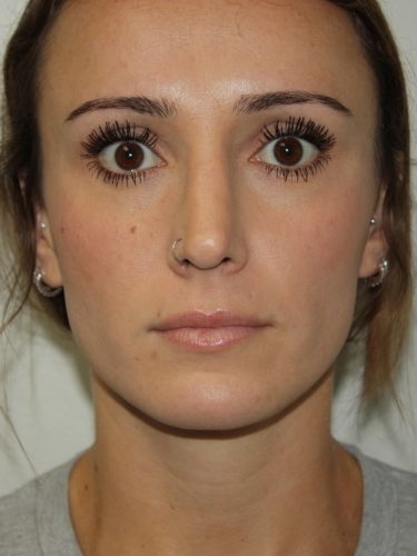 Rhinoplasty Patient 35 - After - 3