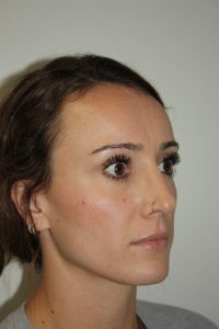 Rhinoplasty Patient 35 - After - 1 Thumbnail