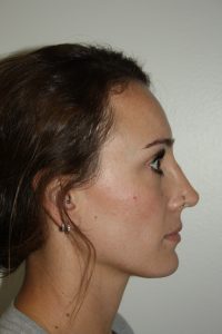 Rhinoplasty Patient 35 - After - 2 Thumbnail
