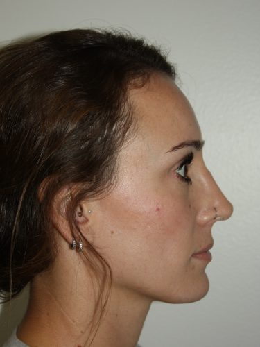 Rhinoplasty Patient 35 - After - 2