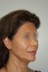 Female Facelift Patient 58 - Before - 1 Thumbnail