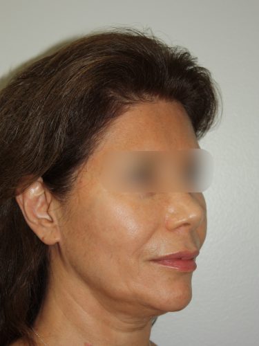 Female Facelift Patient 58 - Before - 1