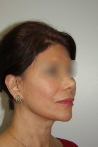Female Facelift Patient 58 - After - 1 Thumbnail