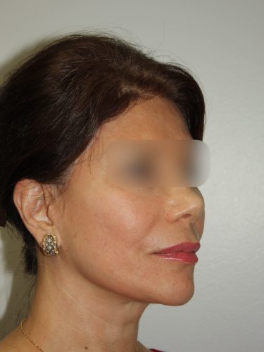 Female Facelift Patient 58 - After - 1