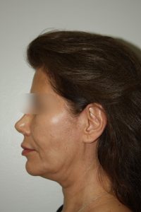 Female Facelift Patient 58 - Before - 3 Thumbnail