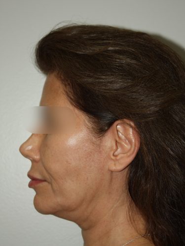 Female Facelift Patient 58 - Before - 3