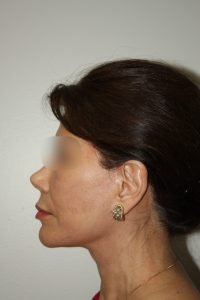 Female Facelift Patient 58 - After - 3 Thumbnail