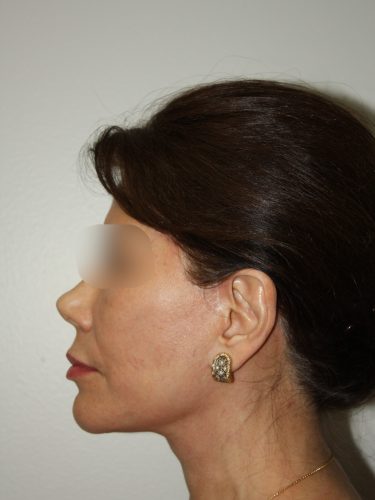 Female Facelift Patient 58 - After - 3