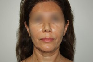 Female Facelift Patient 58 - Before - 2 Thumbnail