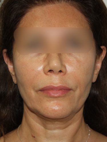 Female Facelift Patient 58 - Before - 2