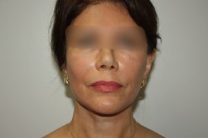 Female Facelift Patient 58 - After - 2 Thumbnail