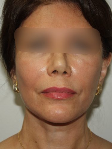 Female Facelift Patient 58 - After - 2