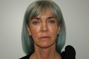 Female Facelift Patient 56 - Before - 2 Thumbnail