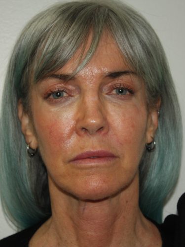 Female Facelift Patient 56 - Before - 2