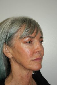 Female Facelift Patient 56 - Before - 1 Thumbnail