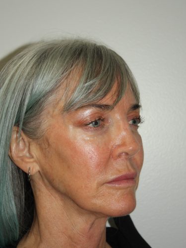 Female Facelift Patient 56 - Before - 1