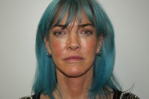 Female Facelift Patient 56 - After - 2 Thumbnail