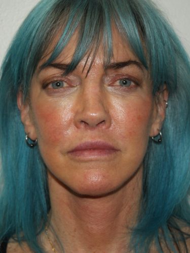 Female Facelift Patient 56 - After - 2