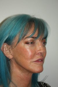 Female Facelift Patient 56 - After - 1 Thumbnail