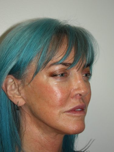 Female Facelift Patient 56 - After - 1