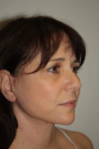 Female Facelift Patient 57 - After - 1 Thumbnail