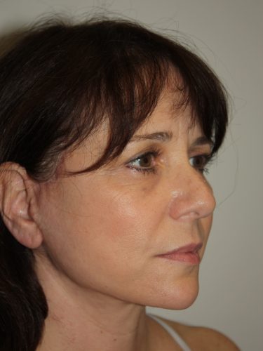 Female Facelift Patient 57 - After - 1