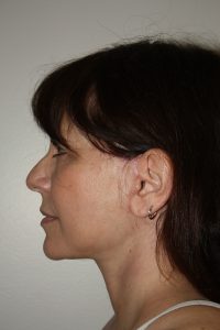 Female Facelift Patient 57 - After - 2 Thumbnail