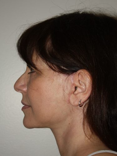 Female Facelift Patient 57 - After - 2