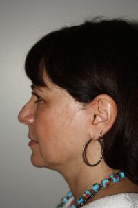 Female Facelift Patient 57 - Before - 2 Thumbnail