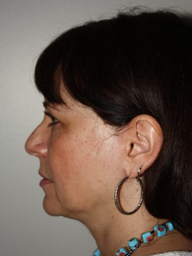 Female Facelift Patient 57 - Before - 2