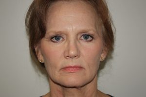 Brow Lift Patient 10 and Facelift - Before - 1 Thumbnail