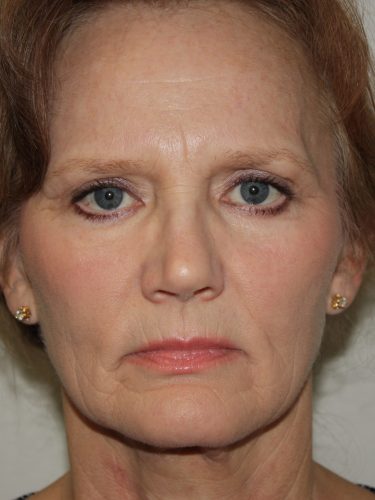 Brow Lift Patient 10 and Facelift - Before - 1