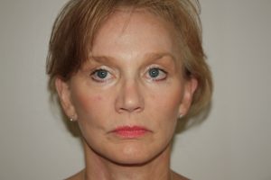 Brow Lift Patient 10 and Facelift - After - 1 Thumbnail