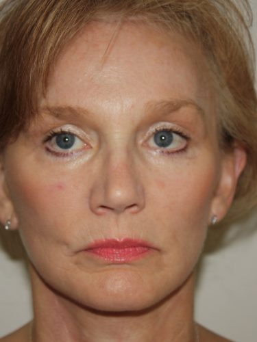 Brow Lift Patient 10 and Facelift - After - 1