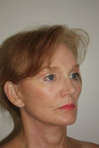 Brow Lift Patient 10 and Facelift - After - 2 Thumbnail