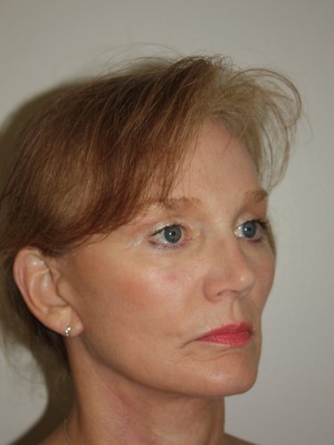 Brow Lift Patient 10 and Facelift - After - 2