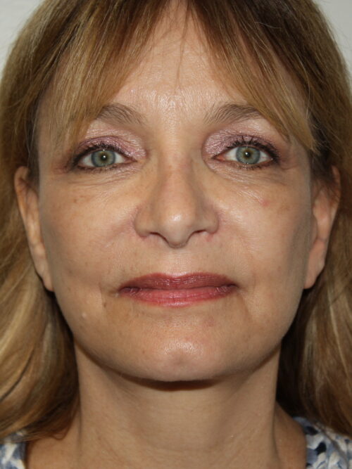 Rhinoplasty Patient 36 - After - 2