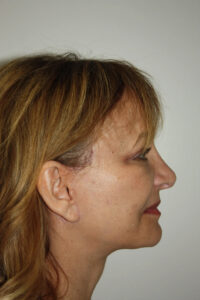 Rhinoplasty Patient 36 - After - 1 Thumbnail