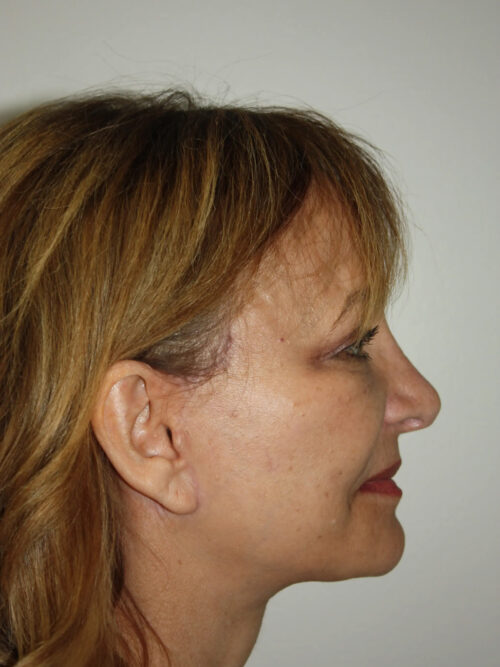 Rhinoplasty Patient 36 - After - 1