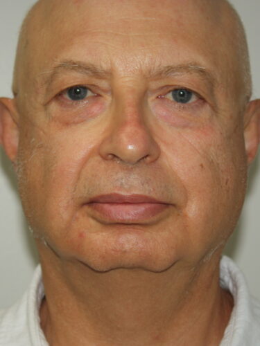 Brow Lift Patient 12 and Facelift - Before - 1